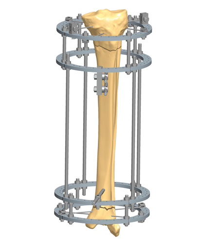 Tibia Fractures 13